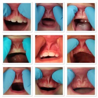 Das zu kurze Zungen- und Lippenband